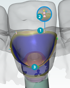 generate abutment buttoms