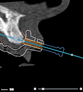 Correct inclination and depth of anchor pins